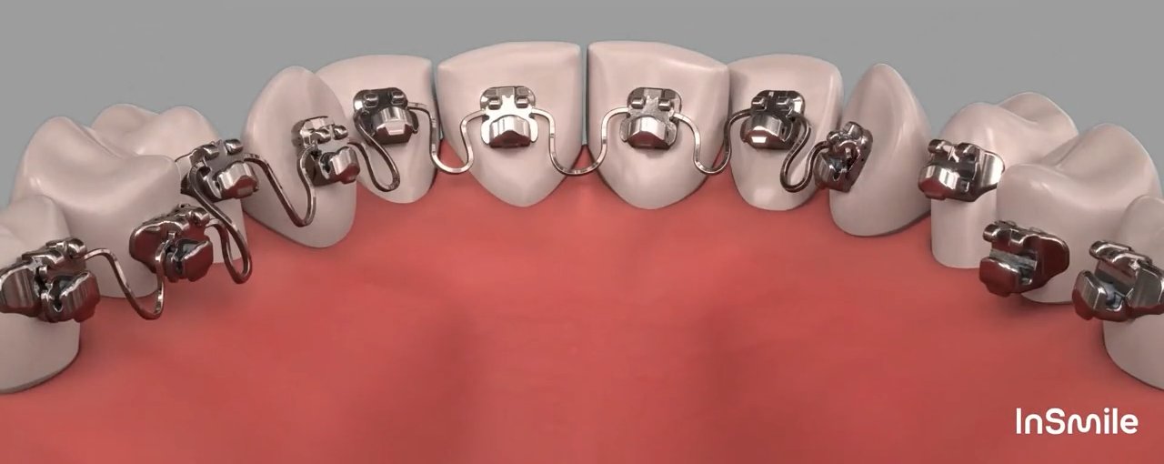 InSmile Hidden Braces placed behind the teeth
